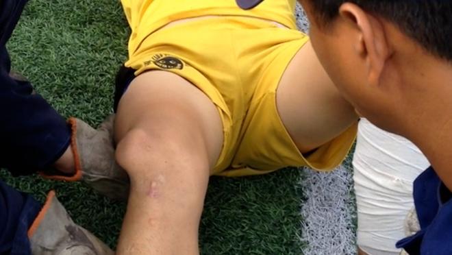 Dislocated Knee Injury