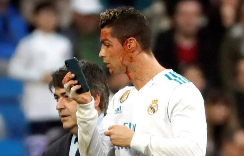 Ronaldo borrows phone to check facial injury